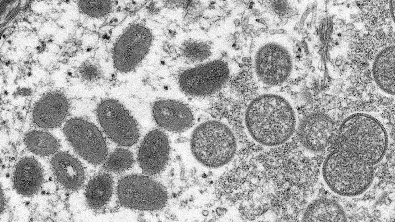 Bilim insanları maymun çiçeği virüsünün kuluçka ve semptom süresini saptadı