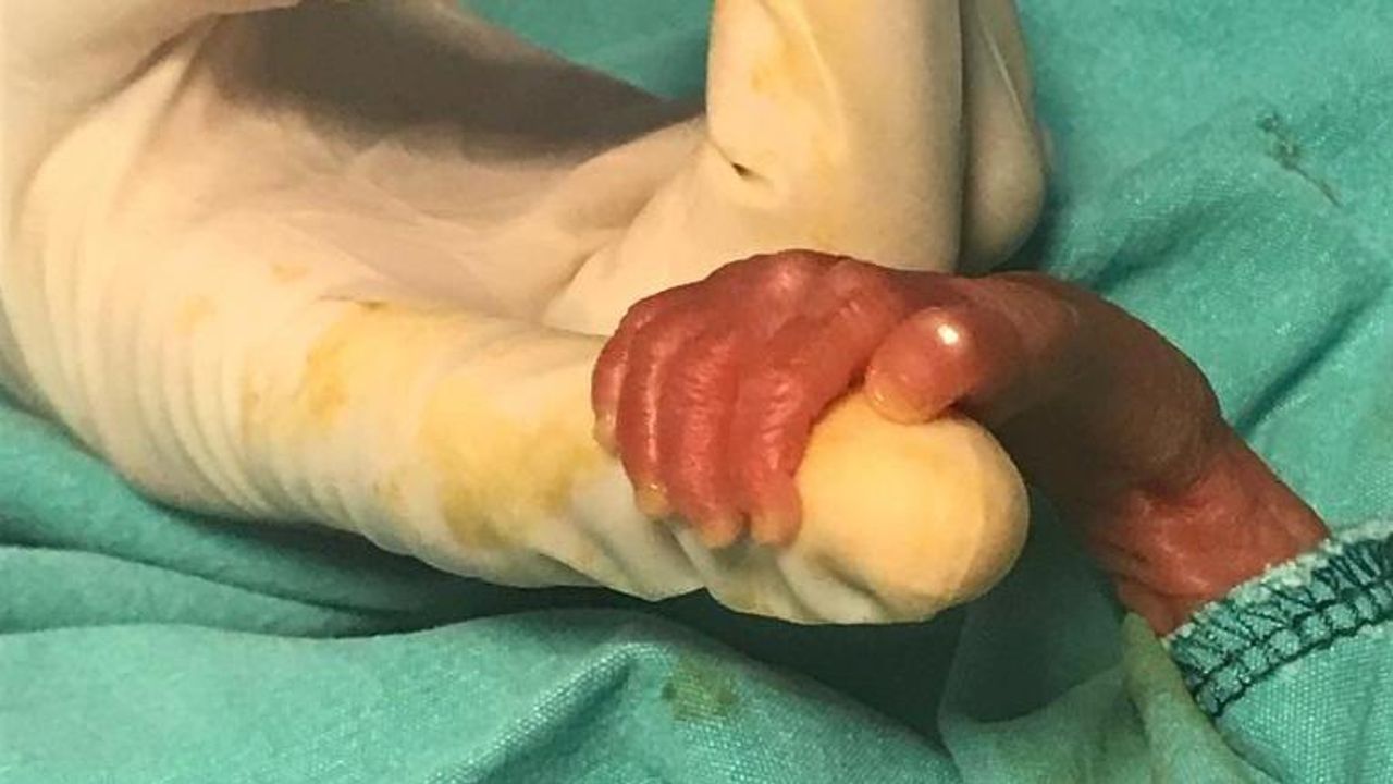 540 gramlık parmak bebeğin mucize yaşamı