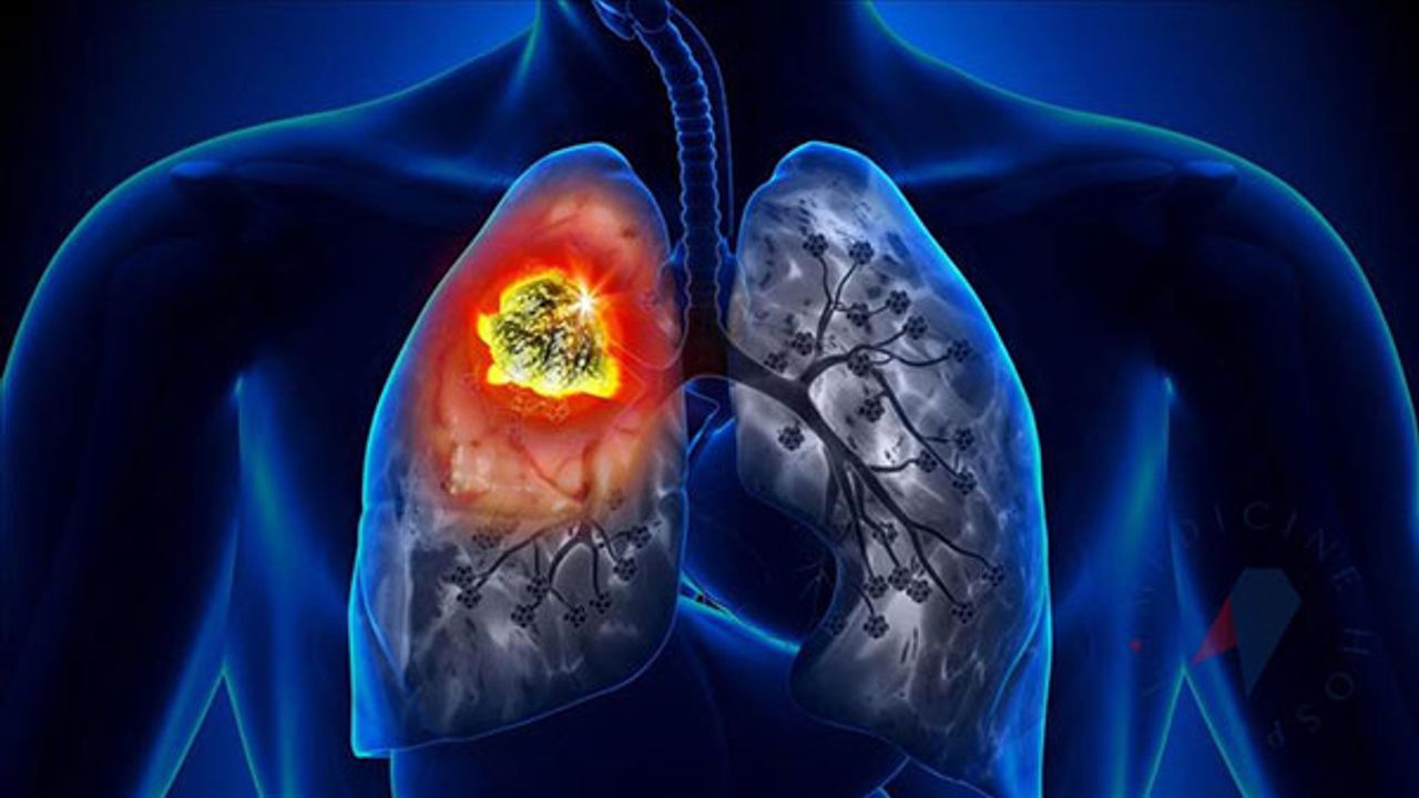 Akciğer kanseri nedir? Akciğer kanserinde güncel tedavi yöntemleri...