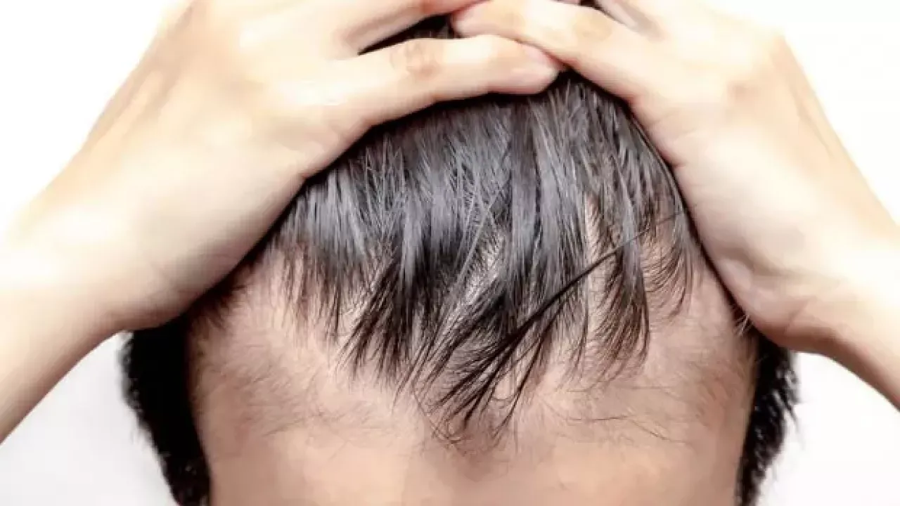 Saç dökülmesi yaşayanlar dikkat! Önüne geçebilirsiniz