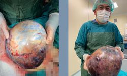 Karın ağrısı şikayetiyle gitti vücudundan 10 kg tümör çıktı