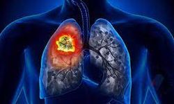 Sigara içenler için; Akciğer kanseri nedir? Belirtileri nelerdir?