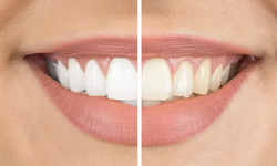 Bu yöntem dişlerinizin rengini 2 kat daha beyaz yapıyor!