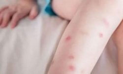Sivrisinek istilası dünyayı sardı! Ölümler artıyor, Türkiye de uyarıldı