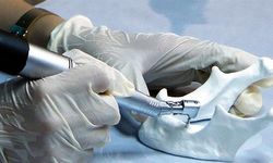 “Alman malı” denilen implant Kore menşeli çıkınca savcılığa başvurdu