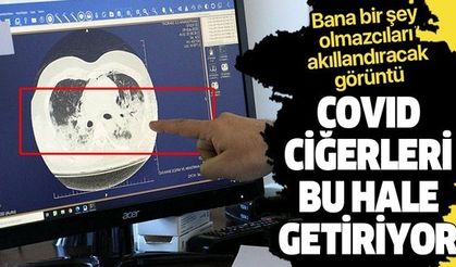 Koronavirüsün akciğerde yarattığı tahribat tomografi görüntülerinde