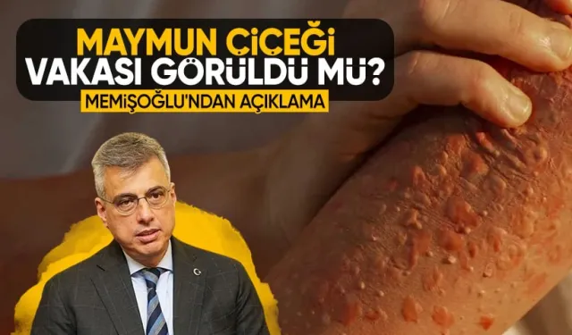 Bakanı Kemal Memişoğlu'ndan maymun çiçeği açıklaması