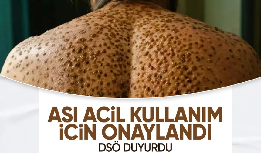 DSÖ, Maymun Çiçeği aşısına acil kullanım onayı verdi